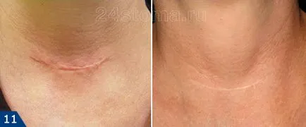 Cum să scapi de cicatrici - crema si unguent pentru cicatrici pe fata (crema unguent cicatrice pentru a scăpa de laser, cezariana inseamna) Cum să scapi de cicatrici - crema si unguent pentru cicatrici pe fata