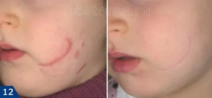 Cum să scapi de cicatrici - crema si unguent pentru cicatrici pe fata (cicatrici) Cum să scapi de cicatrici - crema si unguent pentru cicatrici pe fata