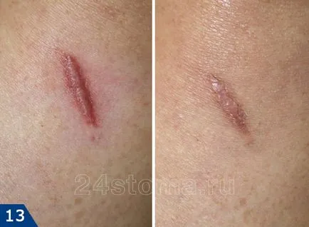 Cum să scapi de cicatrici - crema si unguent pentru cicatrici pe fata (crema unguent cicatrice pentru a scăpa de laser, cezariana inseamna) Cum să scapi de cicatrici - crema si unguent pentru cicatrici pe fata