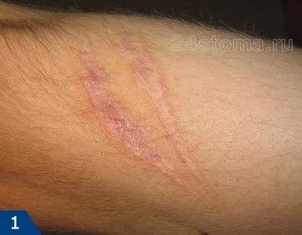 Cum să scapi de cicatrici - crema si unguent pentru cicatrici pe fata (crema) Cum să scapi de cicatrici - crema si unguent pentru cicatrici pe fata