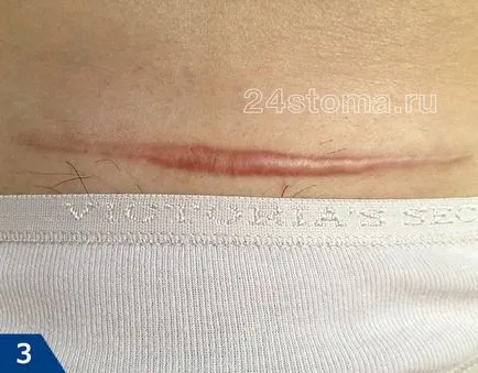 Cum să scapi de cicatrici - crema si unguent pentru cicatrici pe fata (crema unguent cicatrice pentru a scăpa de laser, cezariana inseamna) Cum să scapi de cicatrici - crema si unguent pentru cicatrici pe fata