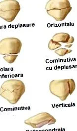 belső rögzítés