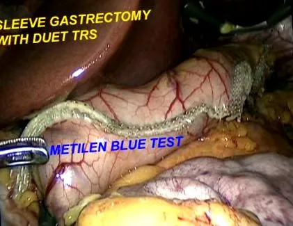 thoracoscopy