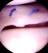 meniscectomia