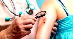 melanoma melanoma