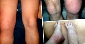osteoarthritisétől osteoarthritisétől
