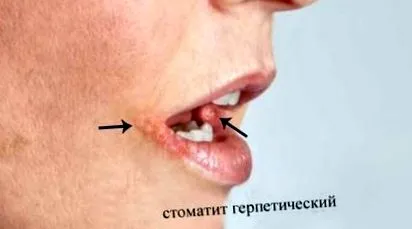 причини