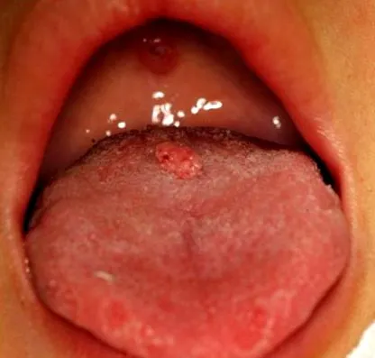 papilloma papilloma