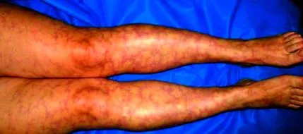 vasculitis gyakori