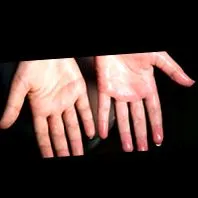 hyperhidrosis