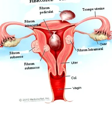 fibroidov