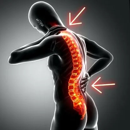 lordosis