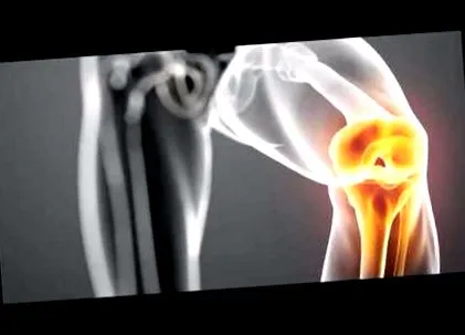 kezelése osteoarthritisének