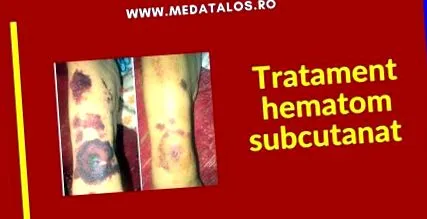 helminták ízületi