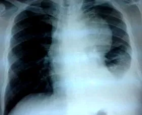 thymoma néhány