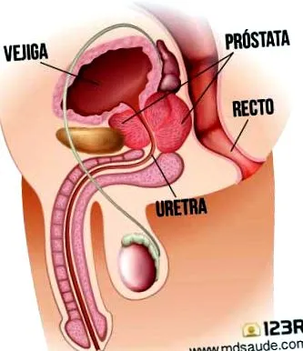 kezelése prosztatarák