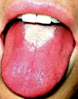 uvula papilloma