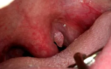 papilloma