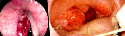 uvula papilloma