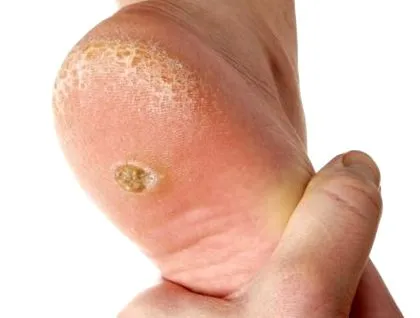 papilloma