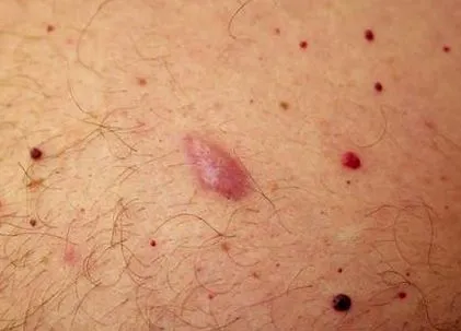 típusai csomó vagy