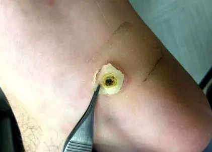 papilloma kezelés