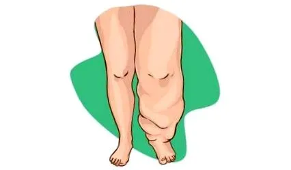 pinwormok