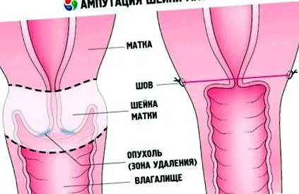 szövődmények következmények