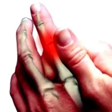 osteoarthritisje fordul