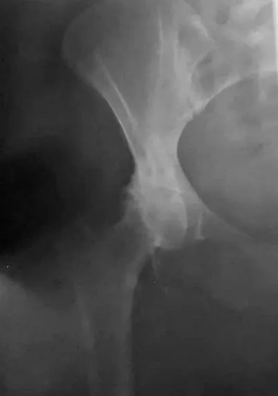 csípőízület osteoarthritisében