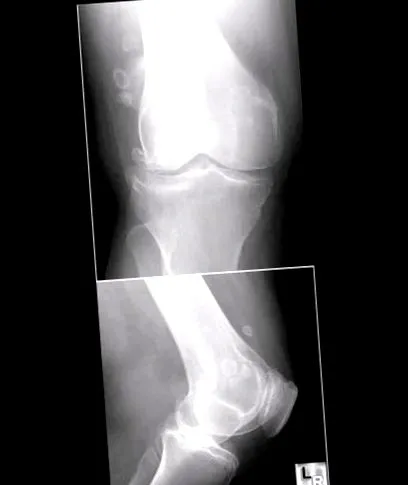 arthritis