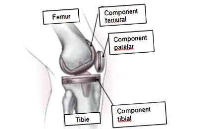 osteoarthritisének