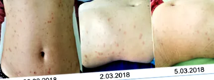 bőrelváltozásokkal