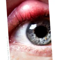 blepharitis