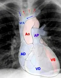 mediastinalis