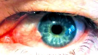 pterygium pinguecula