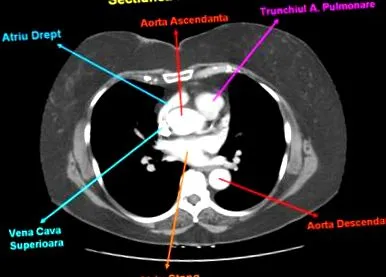 mediastinalis