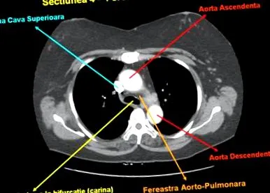 mediastinum