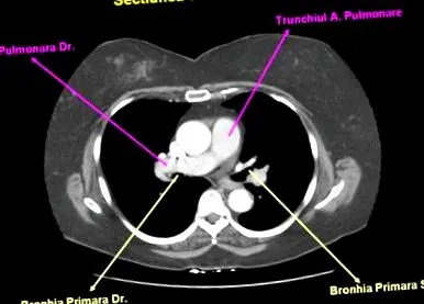mediastinalis