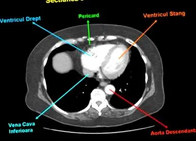 mediastinalis