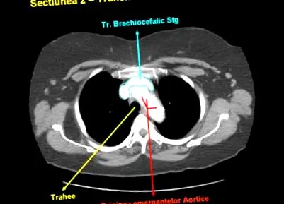 mediastinalis