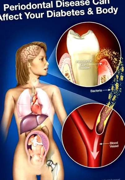 titkos periodontal