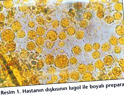 Blastocystis hominis
