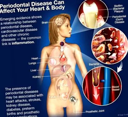 periodontal betegség