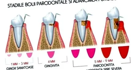 periodontalis