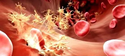 hemophilia