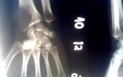 myeloma