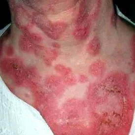 erythema