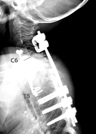 spondylitis