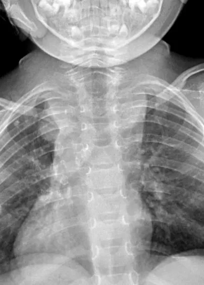 spondylitis